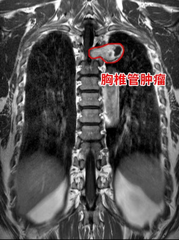 胸锁乳突肌外侧摸到肿物病理_胸锁乳突肌恶性肿瘤_胸锁乳突肌区肿瘤