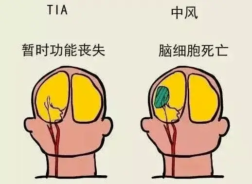 达比加群酯胶囊术前停药_达比加群术前停药时间_手术前达比加群停药